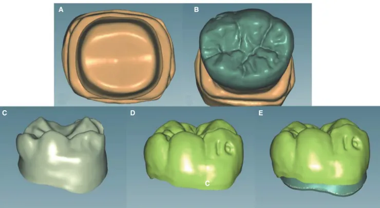Fig. 2.  (A) Scan of stone die, (B) Monolithic crown design, (C) Coping design, (D) Porcelain veneering form design, (E)  Superposition of coping and porcelain veneering forms.
