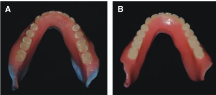 Fig. 1.  (A) Lower wax denture formed by polished  surface impression using a tissue conditioner, (B)  Definitive lower compete denture.
