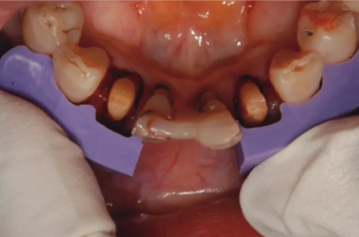 Fig. 3.  Using index standard to delete tooth by the exact  amount.