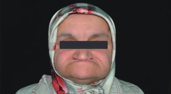 Fig. 5. Extraoral view of the patient before prosthodontic  treatment.