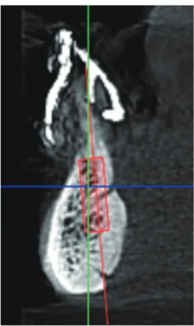 Fig. 1.  CBCT evaluation and electronic surgery.