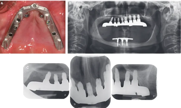 Fig. 4.  (A) View of the Horizontal Denture ®  primary structure screwed directly onto the implant prosthetic platform, (B)  Panoramic X-ray view showing the fit of the upper Horizontal Denture ®  structure, (C) Periapical X-rays showing passive  fit of th