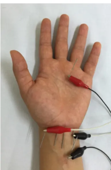 Fig. 1. Acupuncture treatment.