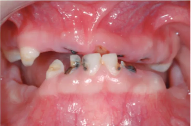 Fig. 1.  Pretreatment intraoral frontal view. Severe dental  caries and multiple loss of primary teeth were presented.