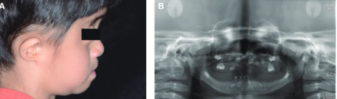 Fig. 7.  Patient showing good adaptation to definitive  prostheses.