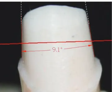Fig. 4.  The measurement of the abutment occlusal  convergence angle by CAD. The two tangent lines (red  solid lines) are mesio-distally established to the cervical  third of the abutment