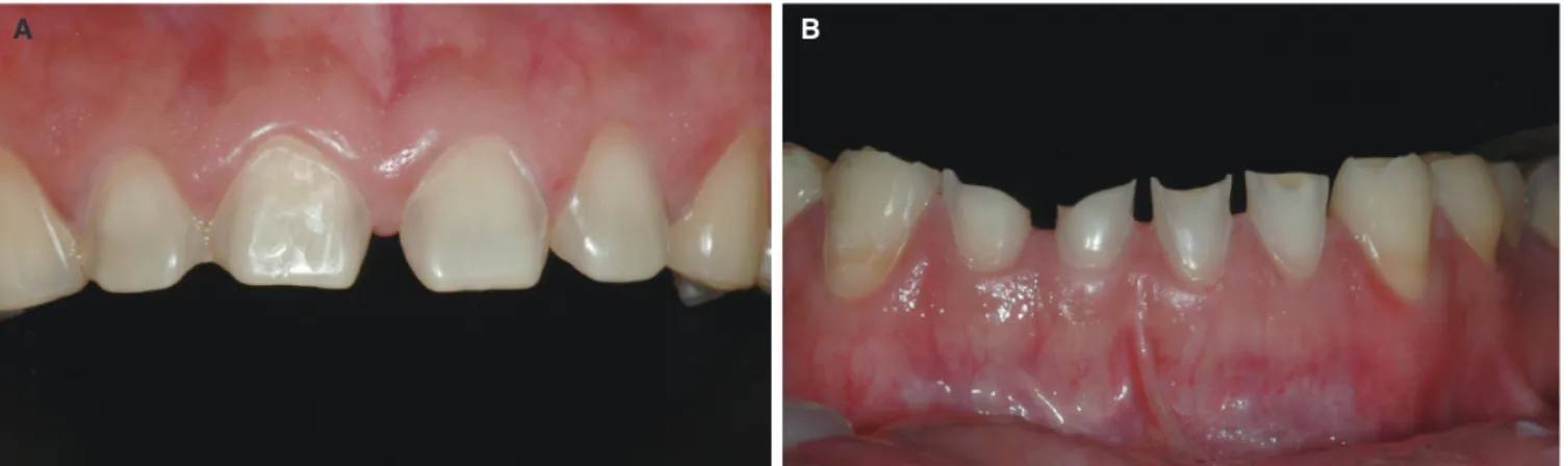 Fig. 2.  (A) Dental erosion patterns in maxillary anterior teeth, (B) dental erosion patterns in mandibular anterior teeth