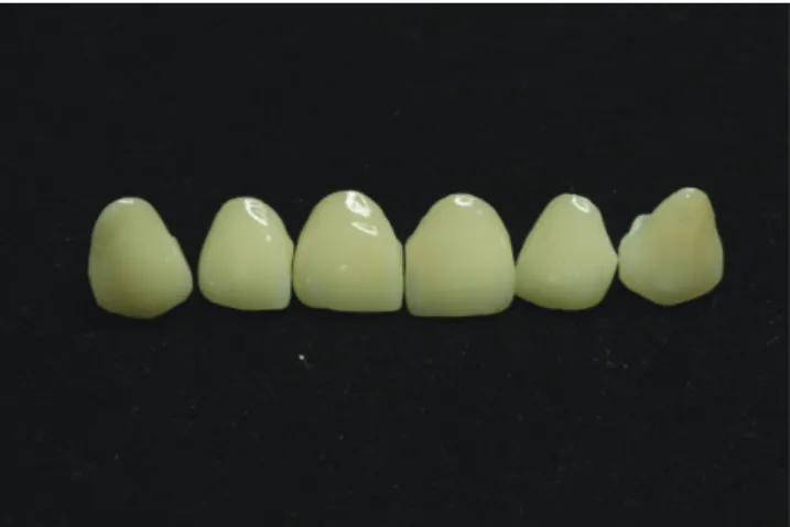 Fig. 3.  Direct intra-oral mock-up made from bis-acryl 