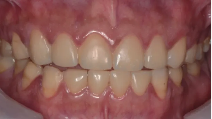 Fig. 5.  Postoperative frontal view at maximum  intercuspal position.
