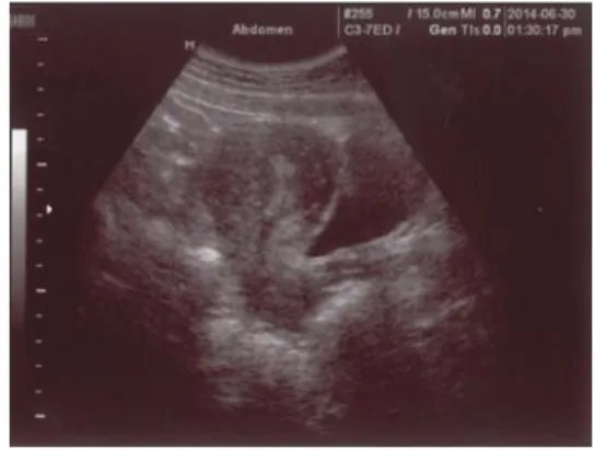 Fig. 1. Ultrasound of case 1 (2014.6.30).