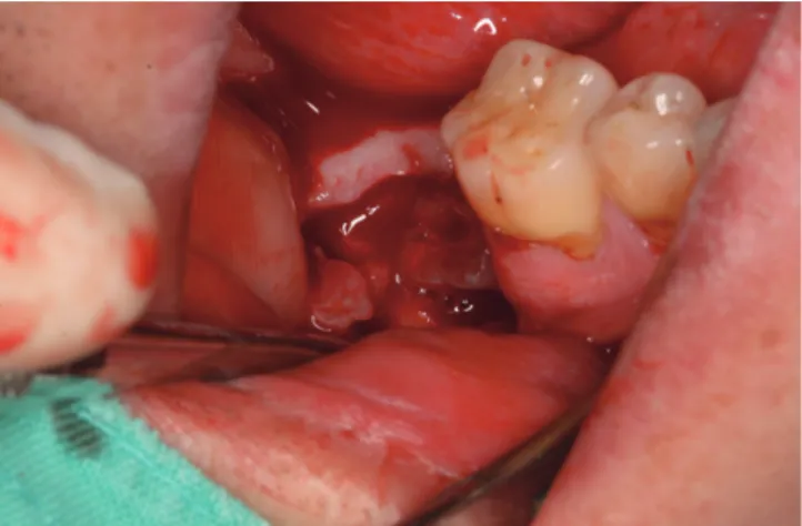 Fig. 2.  AutoBT block was transplanted at the extraction  socket 4 weeks after extraction