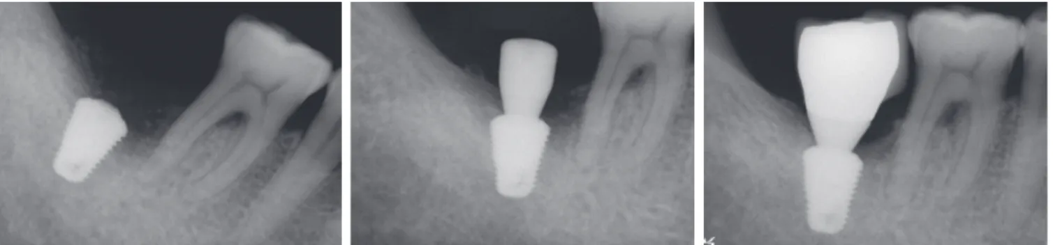 Fig. 6.  An implant was placed. Fig. 7.  The second stage surgery was  achieved 5 months after the implant  placement
