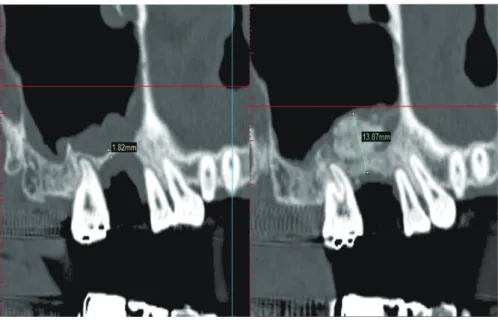 Fig. 2.  Measurement of bone height by Simplant software.