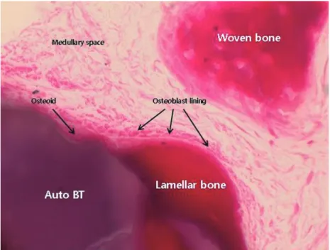 Fig. 6.  Newly-formed and matured lamellar bone was detected surrounding AutoBT material, osteoblasts covering  newly-formed bone accumulated osteoid