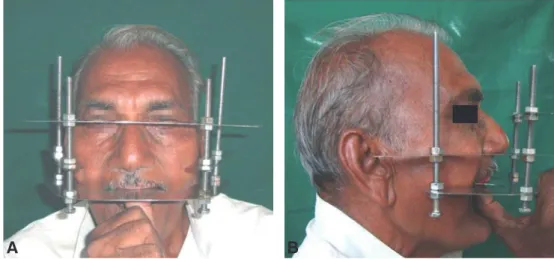 Fig. 3.  Establishing plane of occlusion of maxillary rim using occlusal plane analyzer