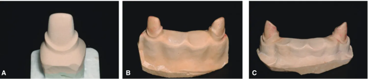 Fig. 2.  Duplicated master models with dental stone. A: single, B: 4-unit, C: 6-unit.