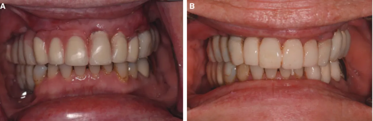 Fig. 4.  A: Implant-tooth retained interim prosthesis, two weeks after implant placement #6, 11, B: mplant  retained interim prosthesis, two weeks after extraction of teeth #9 and 10.