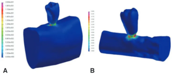 Fig. 3.  The von Mises stress (GPa) distributions in the  finite element models. High concentrations were found  in the surface between abutment and implant body