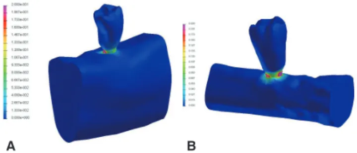 Fig. 3.  The von Mises stress (GPa) distributions in the  finite element models. High concentrations were found  in the surface between abutment and implant body
