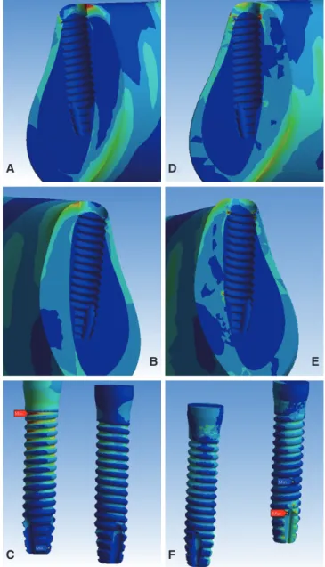 Fig. 4.  (A), (B), (C): showing von Mises stresses of the first  model at bone cross section surrounding first implant,  second implant and implant surfaces, respectively, (D),  (E), (F): showing von Mises stresses of the second model  at bone cross sectio