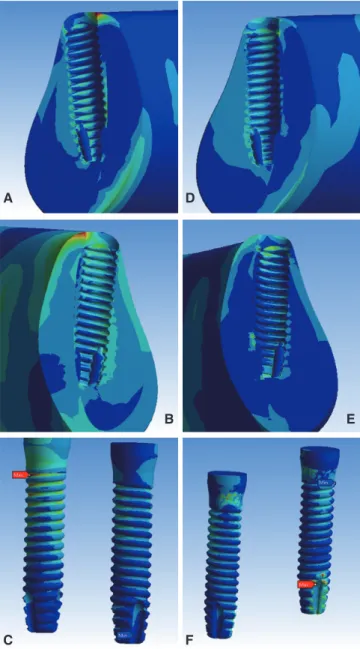 Fig. 7.  Maximum equivalent strains of bone around both  implants and surfaces of each implant in both Model 1  and 2.4035302520151050