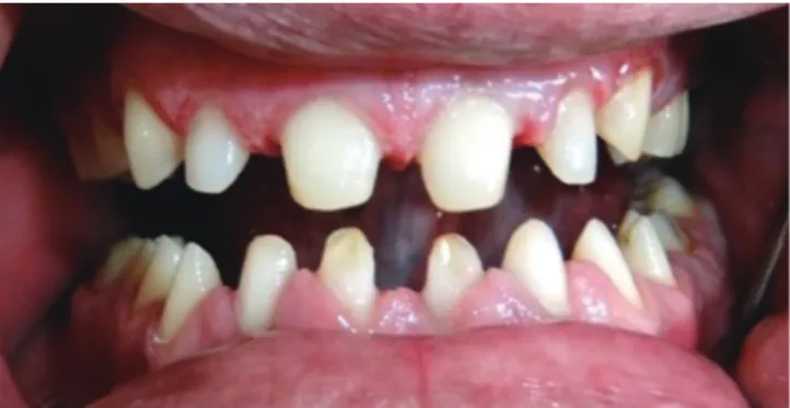 Fig. 3.  Occlusal splint fabricated to evaluate the adapta- adapta-tion of the patient to altered occlusal vertical dimension.