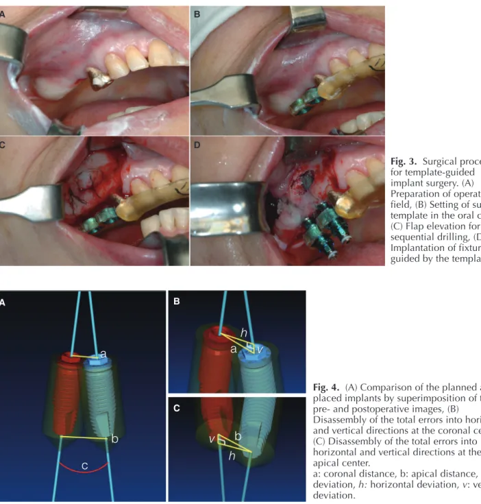 Fig. 3.  Surgical procedure  for template-guided  implant surgery. (A)  Preparation of operation  field, (B) Setting of surgical  template in the oral cavity,  (C) Flap elevation for  sequential drilling, (D)  Implantation of fixture  guided by the templat