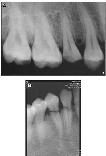 Fig. 2. Preoperative buccal view showing fractured maxillary second pre- pre-molar.