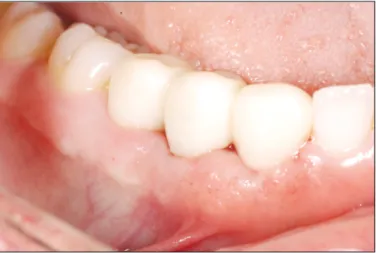 Fig.  6.  Postoperative  buccal  view  following  four  weeks  of  implant placement and loading.