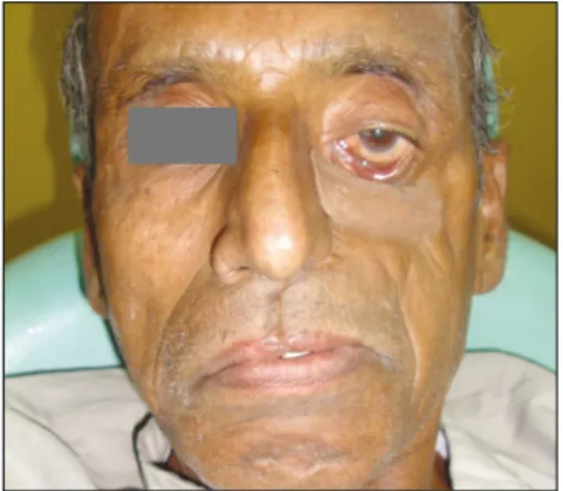 Fig. 2. Facial moulage impression made with irreversible hydrocolloid impression material.