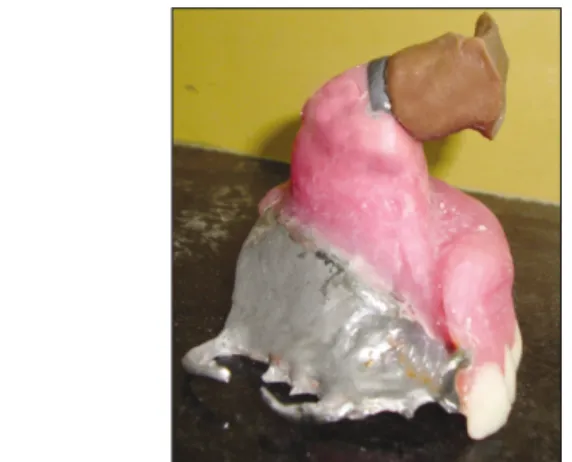 Fig. 7. Intraoral prosthesis attached to extra oral prosthesis.