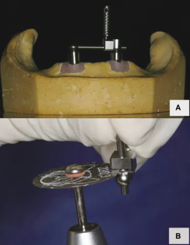 Fig. 5. Extraoral photographs. A: Before delivery of final denture, B: After delivery of final denture.