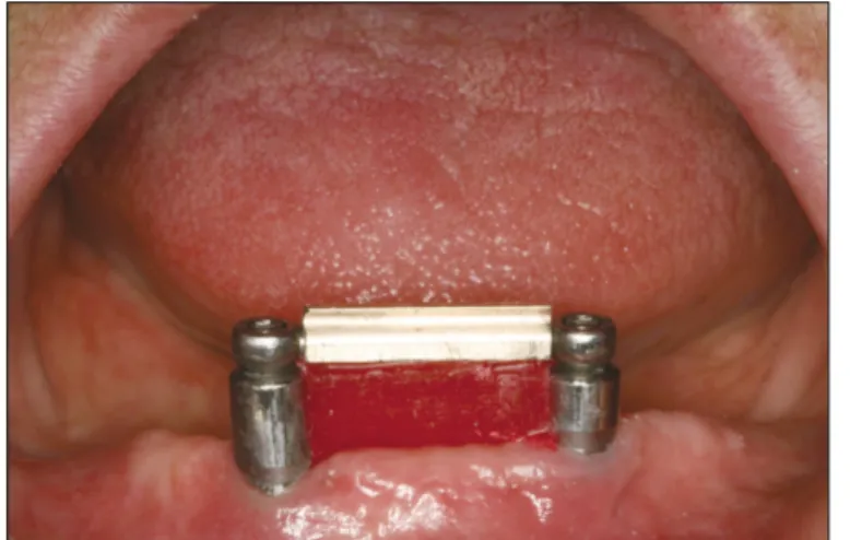 Fig. 6. The space under the bar was blocked out with utility wax.