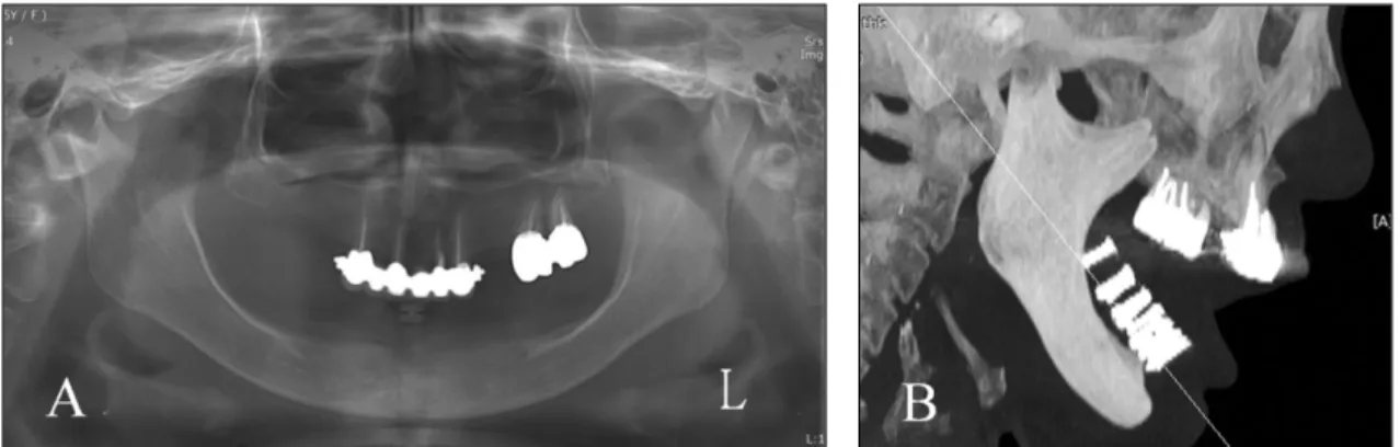 Fig. 1. Preoperative panoramic radiograph (A) and lateral tomographic view (B). 