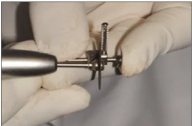Fig.  5. Seated  adaptors  and  adjusted  tube  bar  were  reconnected  by mechanical interlocking.