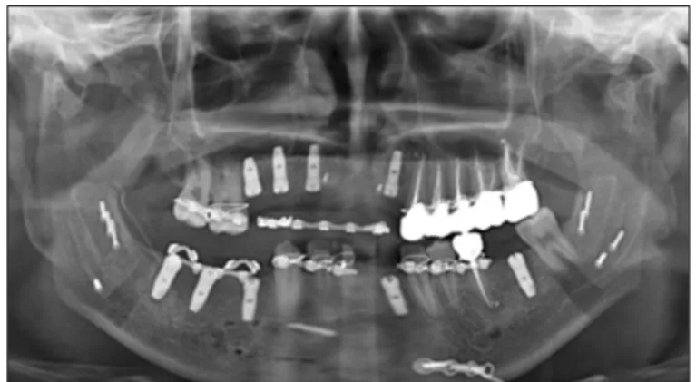 Fig. 5. Panoramic radiograph after implant and BSSRO surgery.