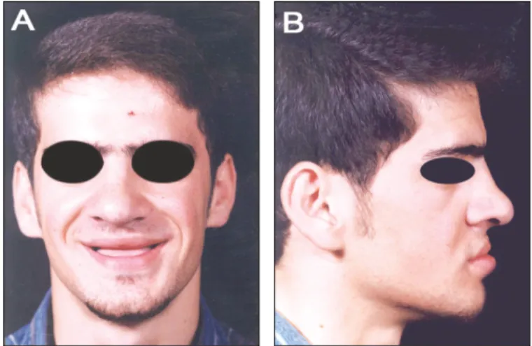 Fig. 3. A, B: Pretreatment CT scan finding of the study prior to the bone augmentation.