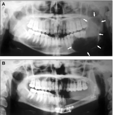 Fig. 1. A: Pre-operative panoramic radiograph showing extensive radi- radi-olucent area in left mandible, B: Post-surgical panoramic radiograph  show-ing reconstructed left mandible with osseous graft.