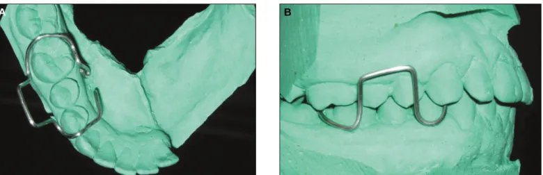 Fig. 3. A: Wire substructure: occlusal view, B: Wire substructure: buccal view.