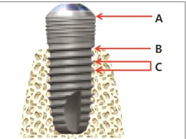 Fig. 3. Age distribution of the patient at the implant installation.