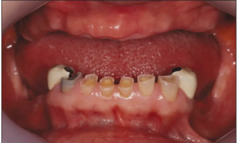 Fig. 3. Analysis of diagnostic cast. Determination of the length of sur- sur-gical crown lengthening.