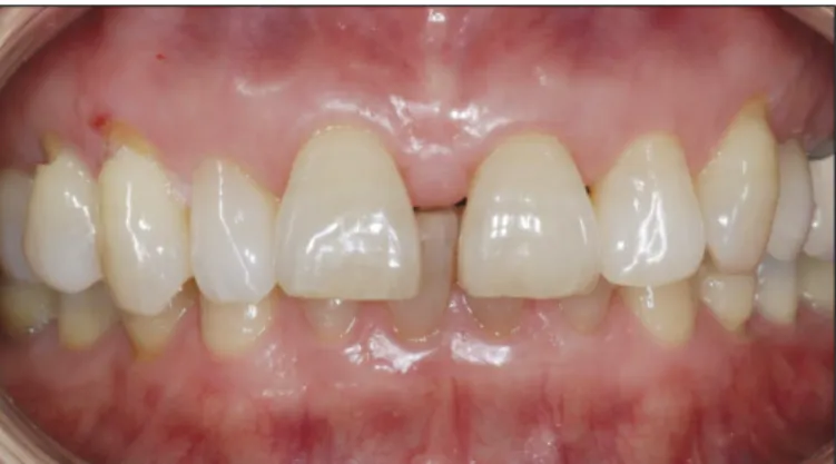 Fig. 2. Diagnostic wax-up was performed on the supposition that #11 and