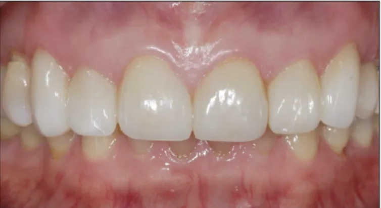 Fig. 5. Frontal view of definitive porcelain laminate veneers. 