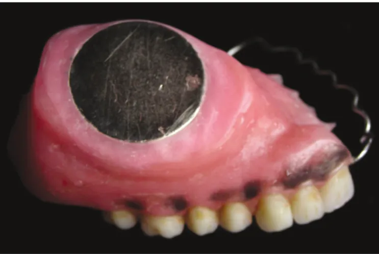 Fig. 3. Magnet embedded into superior-lateral aspect of obturator pros- pros-thesis.