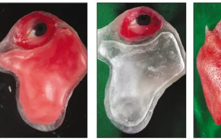 Fig.  5. Wax  sheet  contoured  to allow 3 mm of uniform thickness of silicone  for  future  normal  facial contour