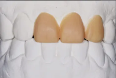 Fig.  2. Minor  tooth  rearrangement  was  completed.  The  space  of maxillary left lateral incisor became equal to that of maxillary right central incisor