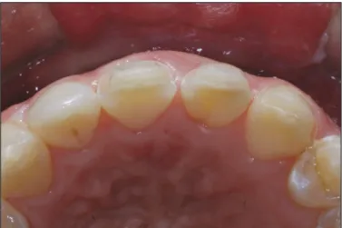 Fig. 6. Porcelain laminate veneers were checked on the master cast for esthetics and adaptation.