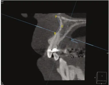 Fig. 3. Buccal bony curvature angle (∠PQR) below root apex of max- max-illary anterior teeth