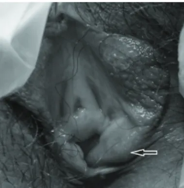 Fig. 2. Swelling and Erythema of Vulva  (2013.10.07.).