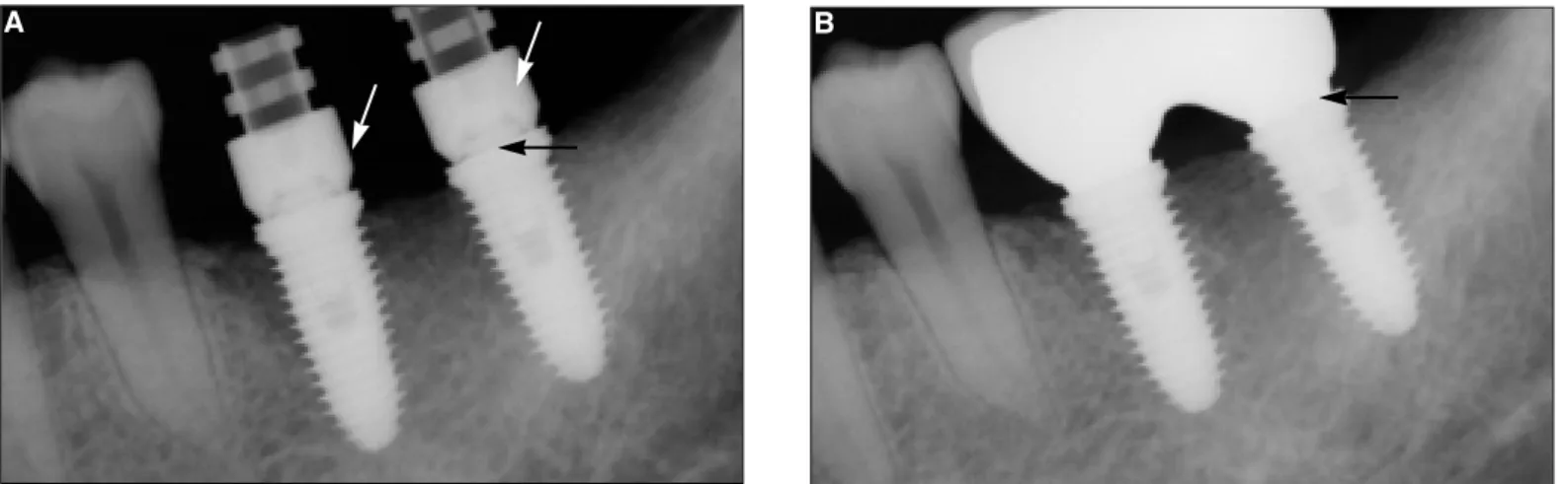 Fig. 1. (A) Two implants (SinusQuick TM EB, Neobiotech Co., Seoul, Korea) were inserted at #36 and #37 area (black arrows)